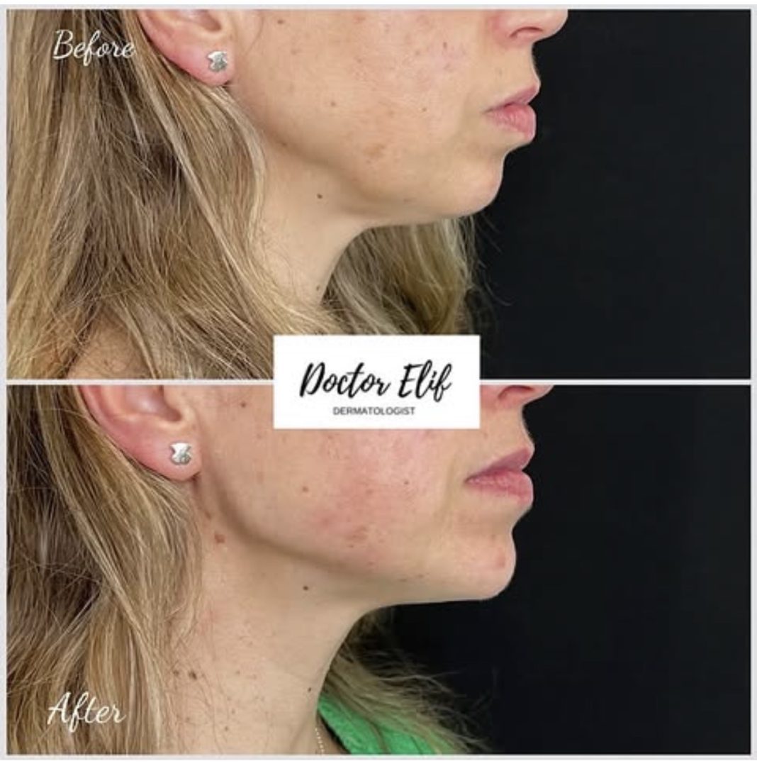 Jawline Filler