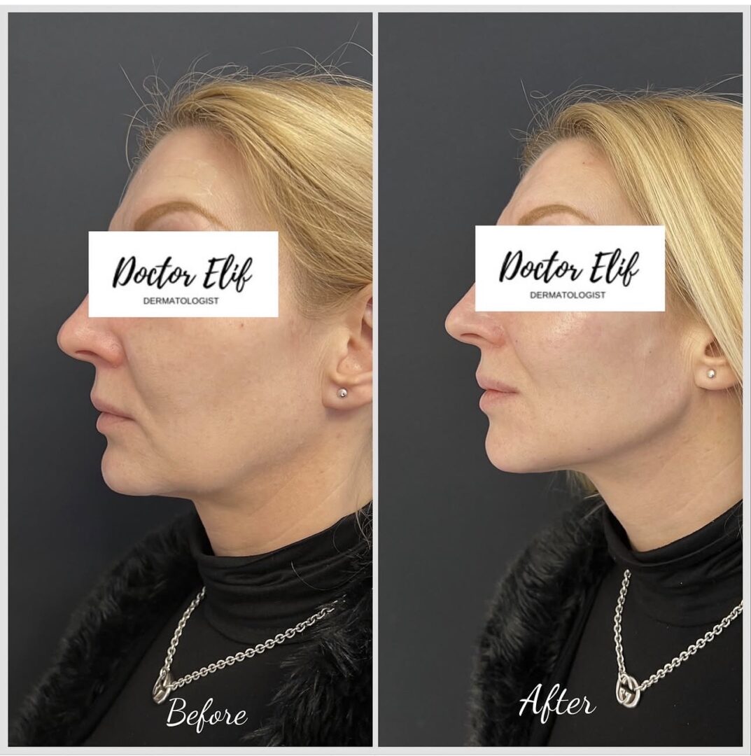 Jawline Filler