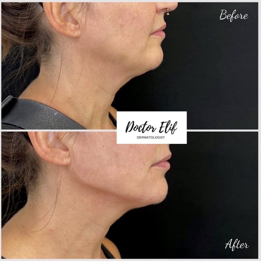 Jawline Filler
