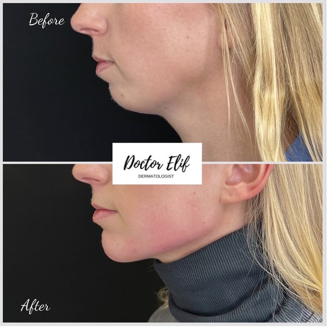 Jawline Filler