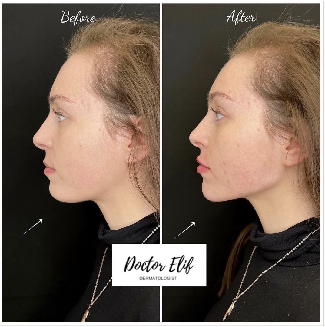 Jawline Filler