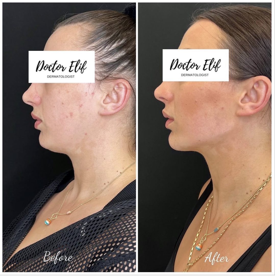 Jawline Filler