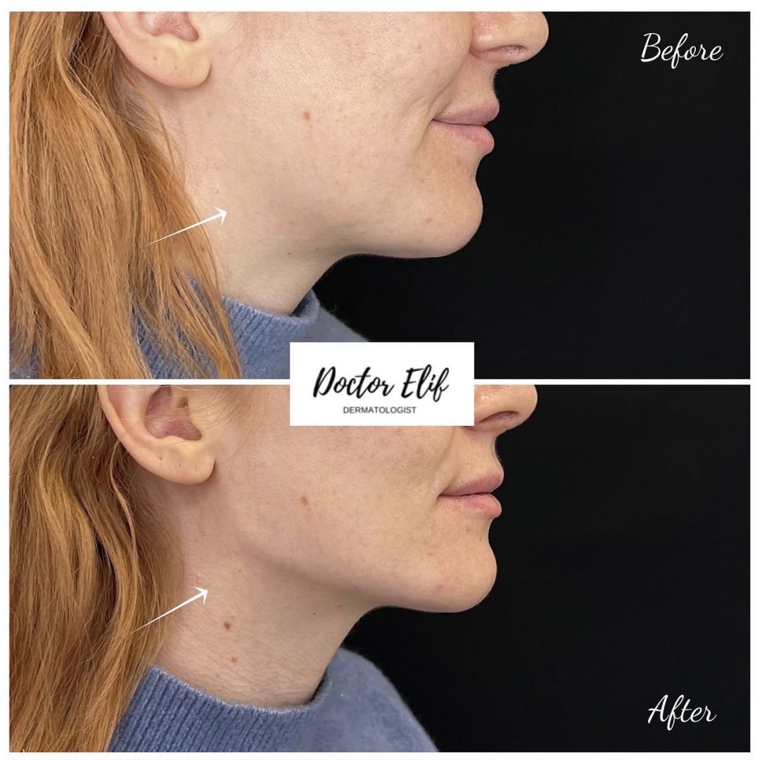 Jawline Filler
