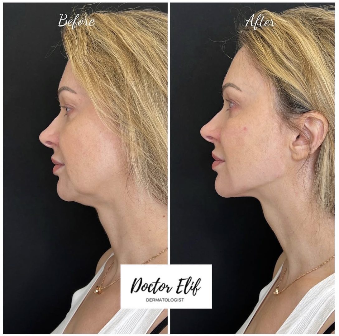 Jawline Filler