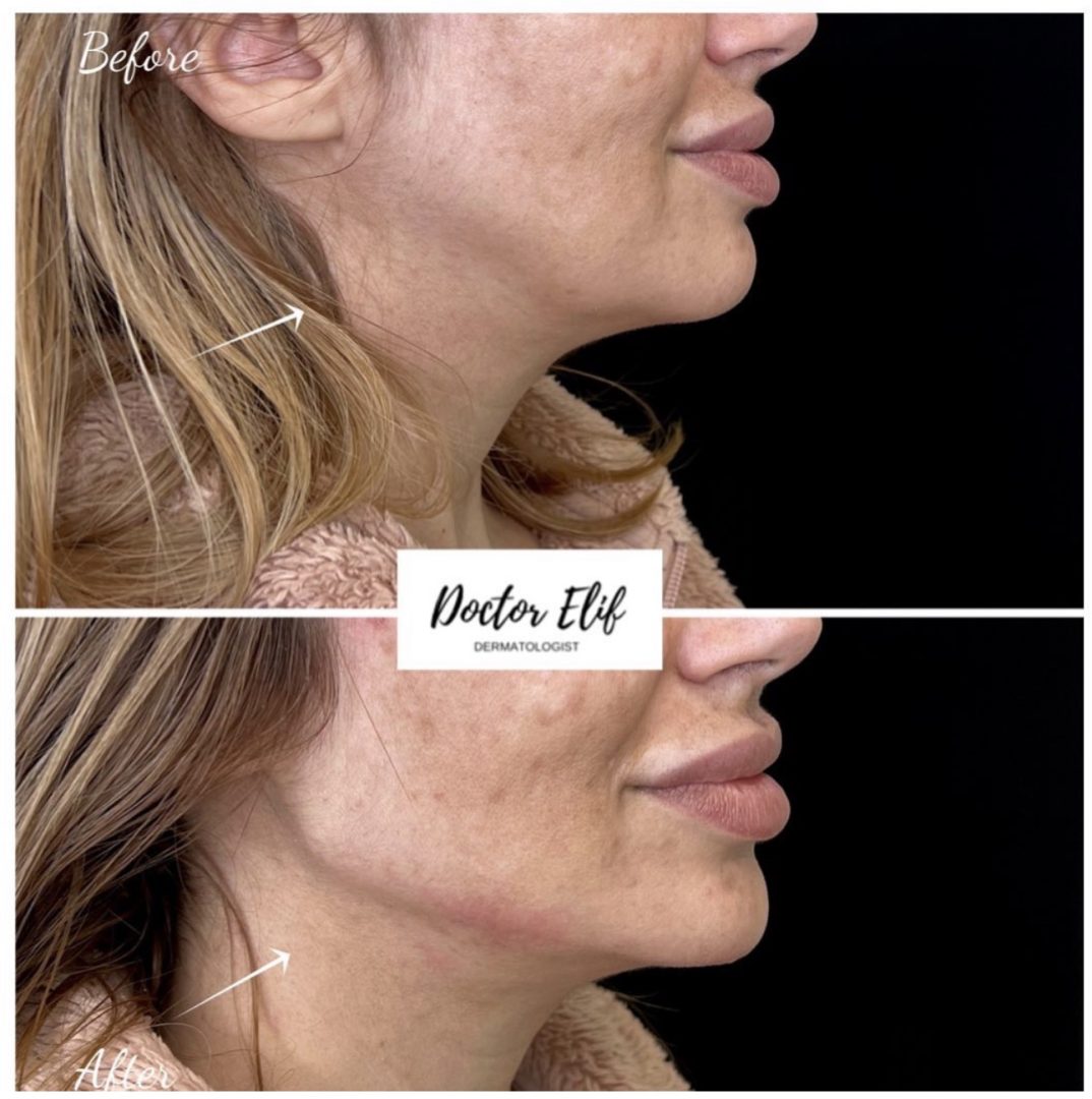 Jawline Filler