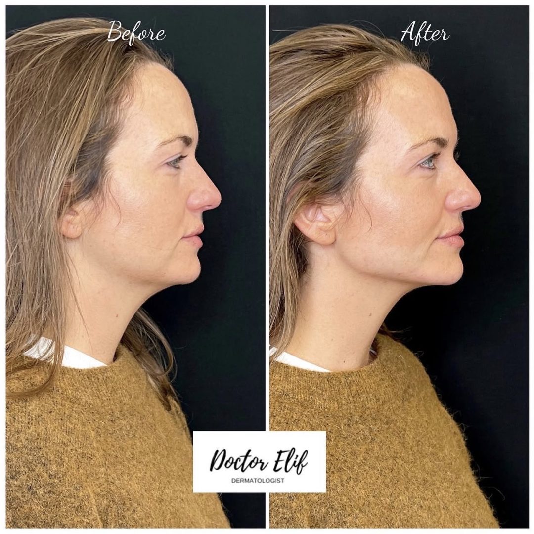 Jawline Filler