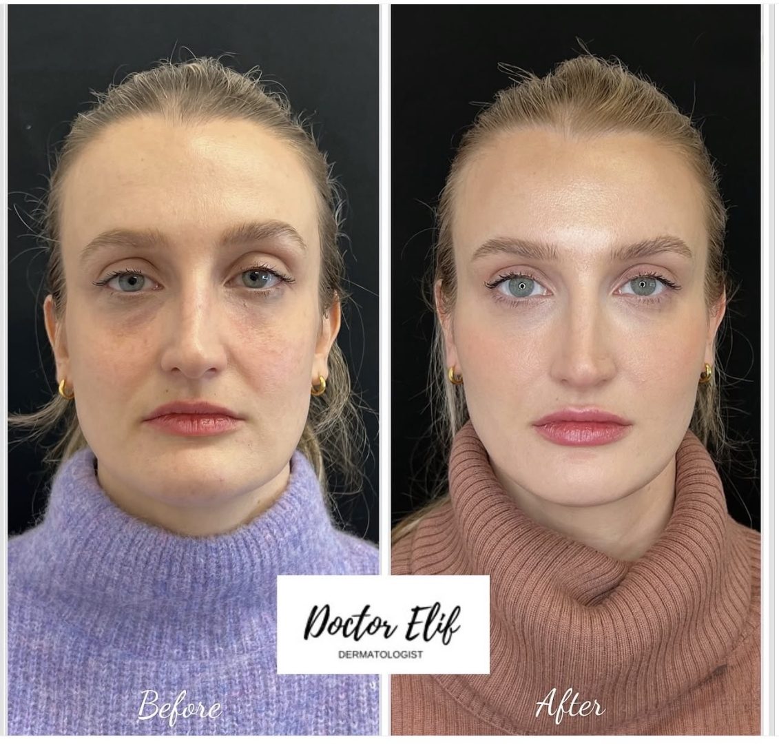 Cheek Fillers
