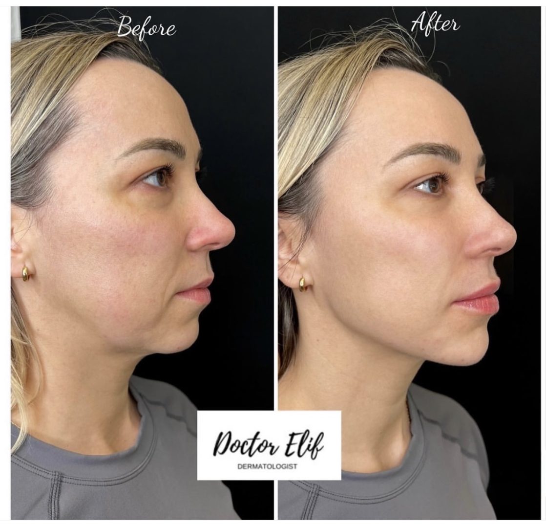 Cheek Fillers