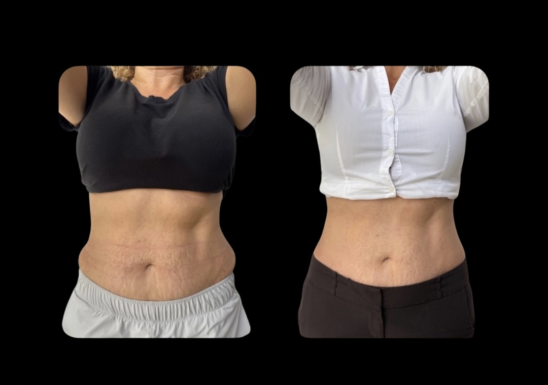 HIFU – High Intensity Focused Ultrasound
