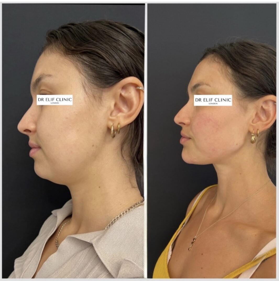 Dr Elif Face Slim Treatment