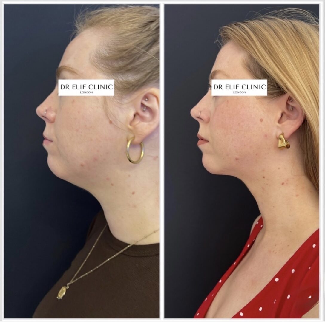Dr Elif Face Slim Treatment