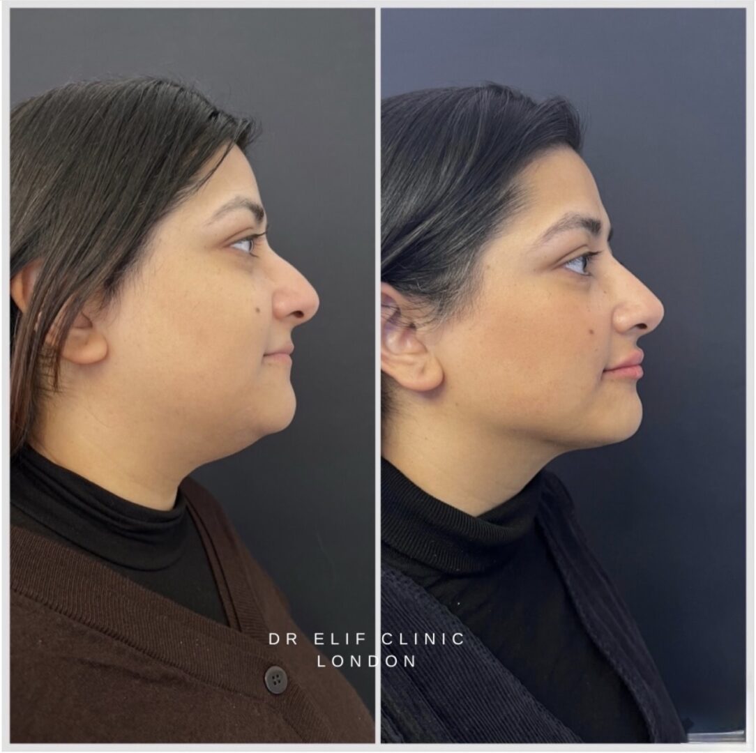 Dr Elif Face Slim Treatment
