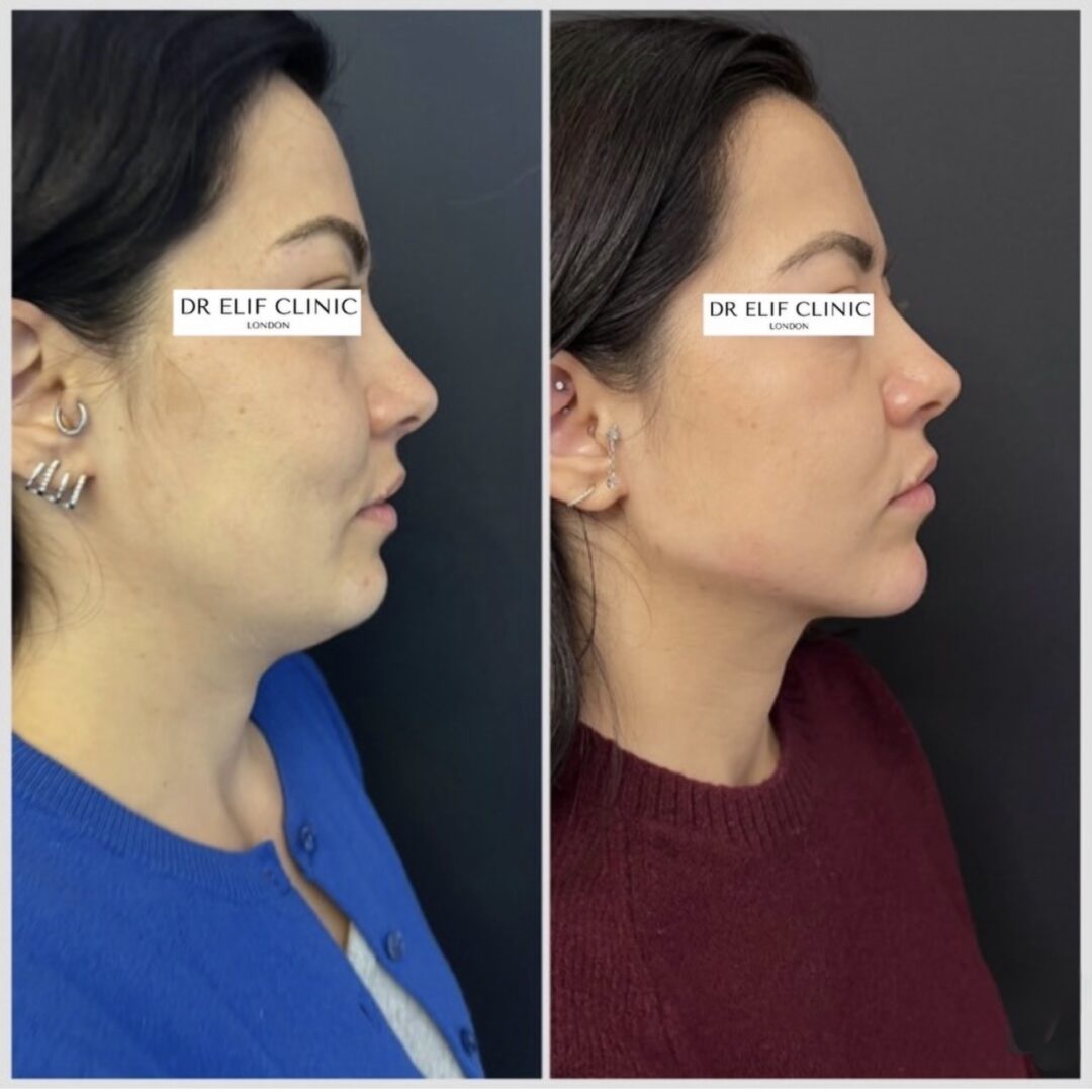 Dr Elif Face Slim Treatment