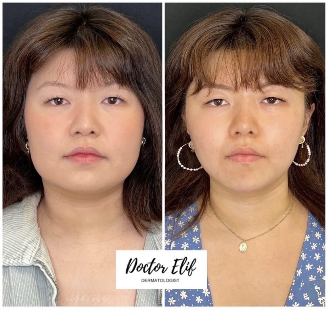 Dr Elif Face Slim Treatment