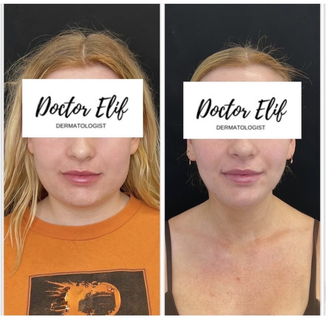 Dr Elif Face Slim Treatment