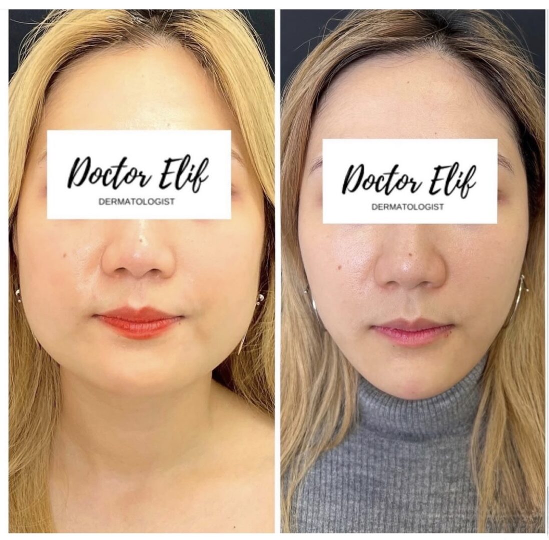 Dr Elif Face Slim Treatment