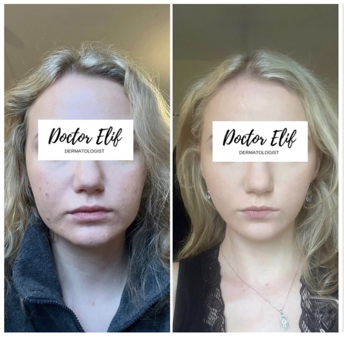 Dr Elif Face Slim Treatment