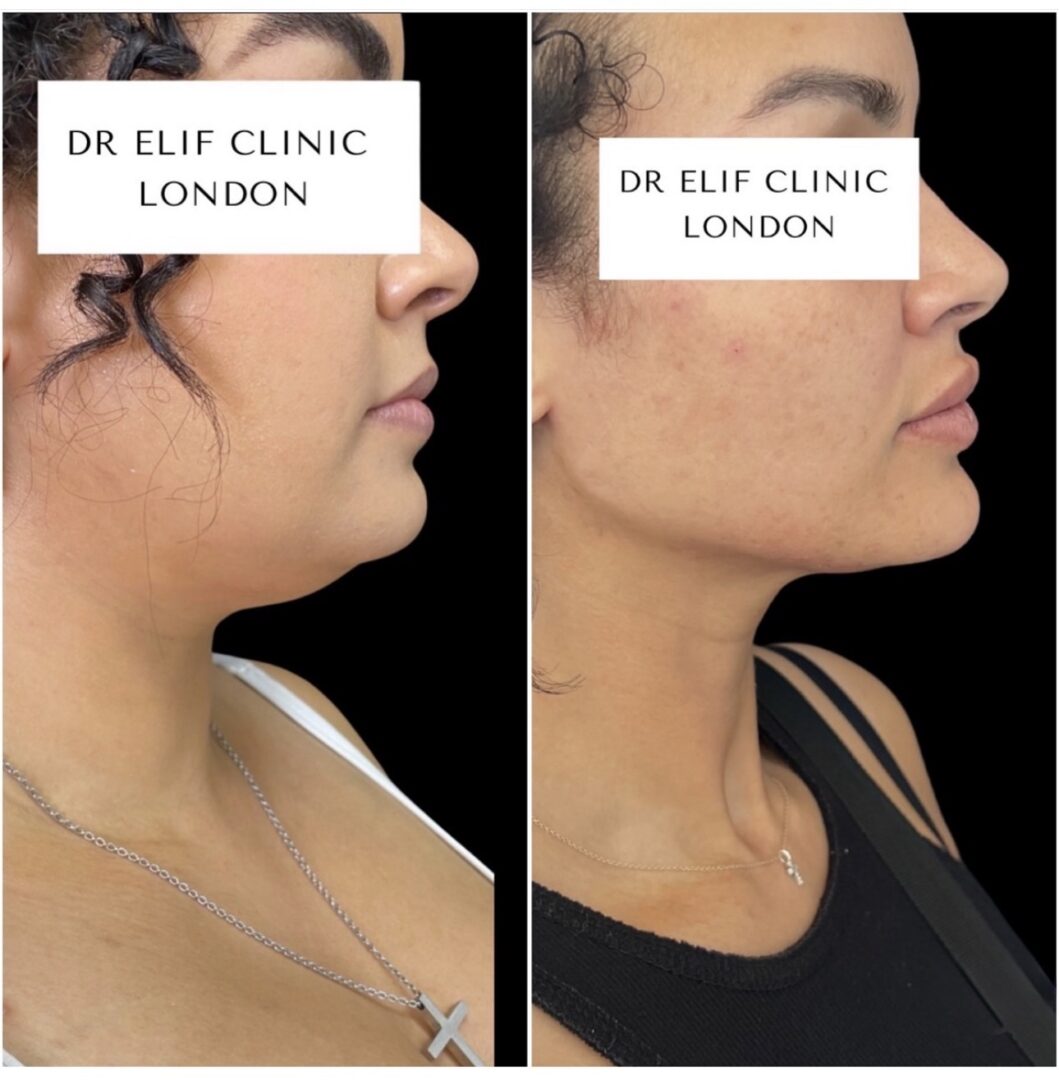 Dr Elif Face Slim Treatment