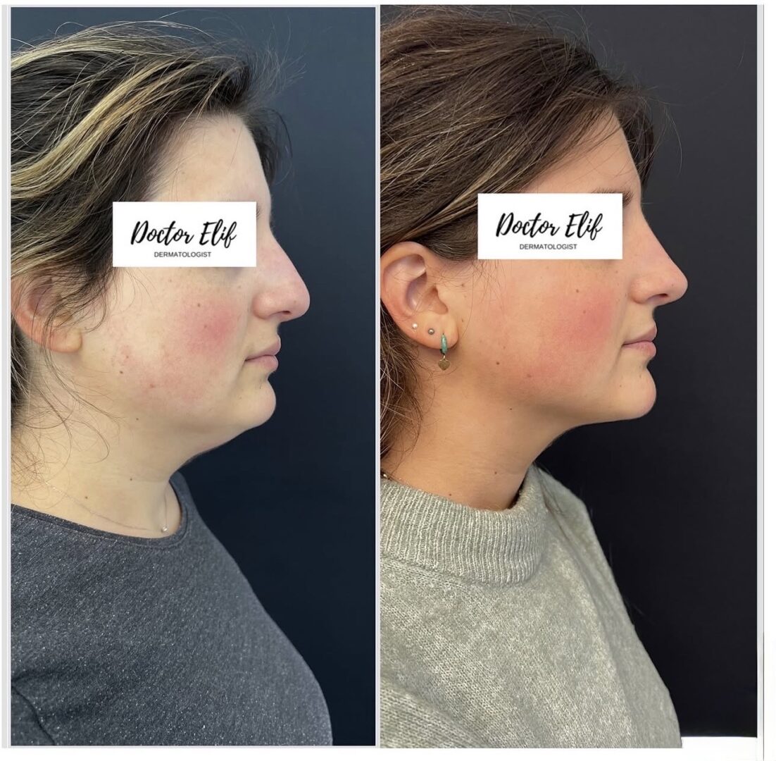 Dr Elif Face Slim Treatment