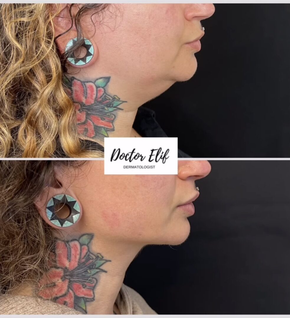 Dr Elif Face Slim Treatment