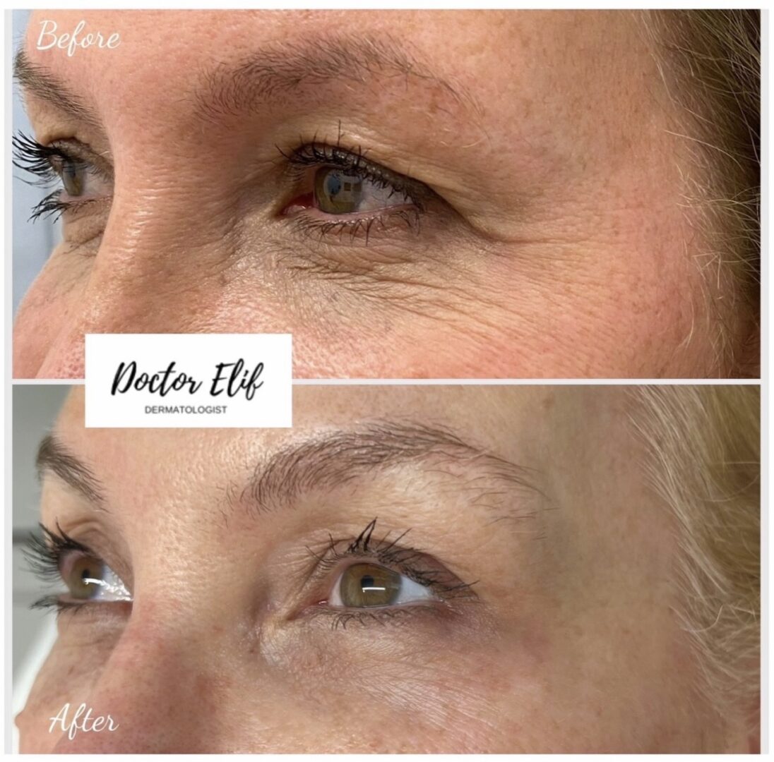 Dr Elif wrinkle-free under eye treatment