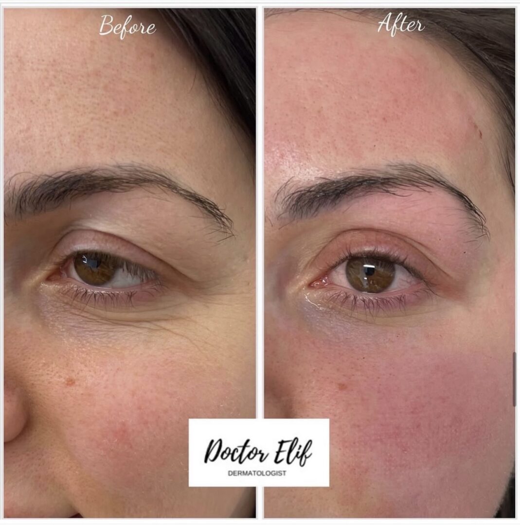 Dr Elif wrinkle-free under eye treatment