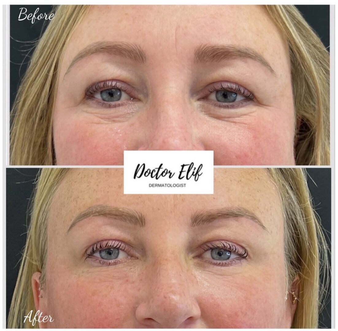 Dr Elif wrinkle-free under eye treatment