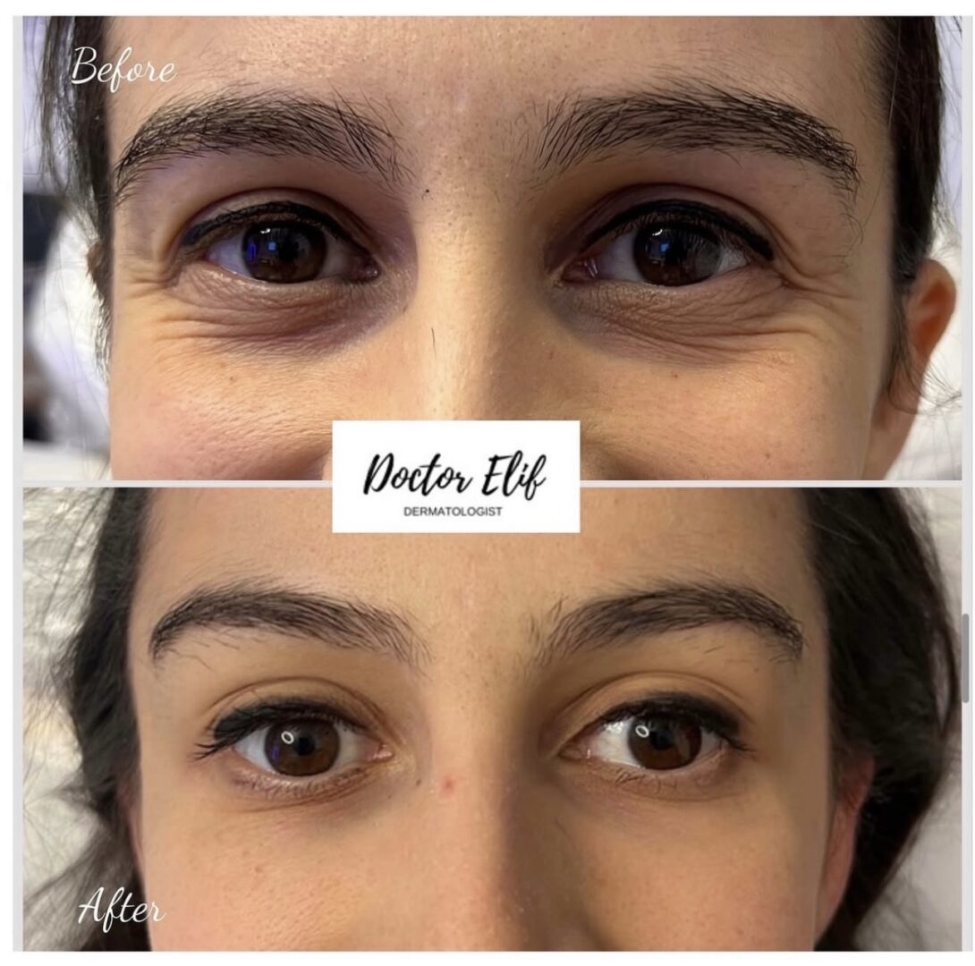 Dr Elif wrinkle-free under eye treatment