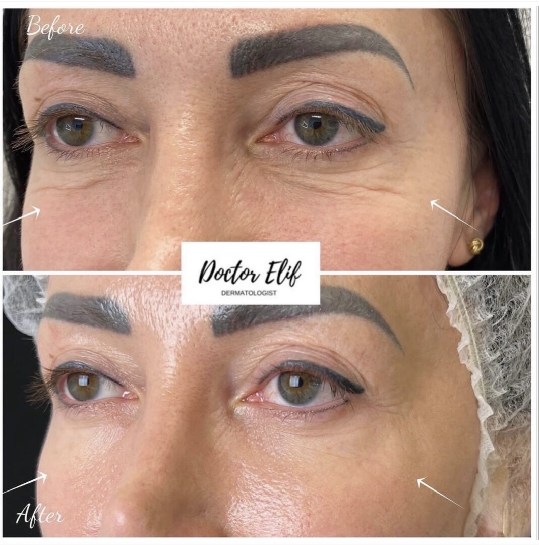 Dr Elif wrinkle-free under eye treatment