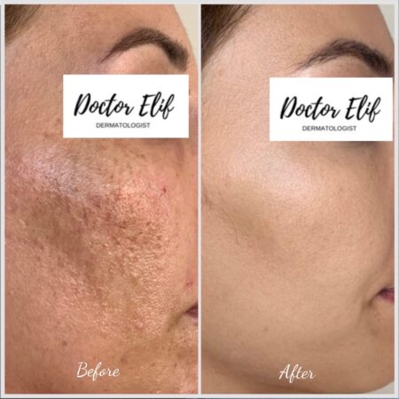 acne scar treatment
