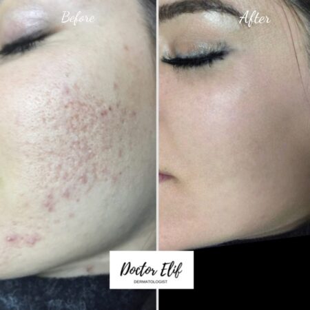 acne scar treatment