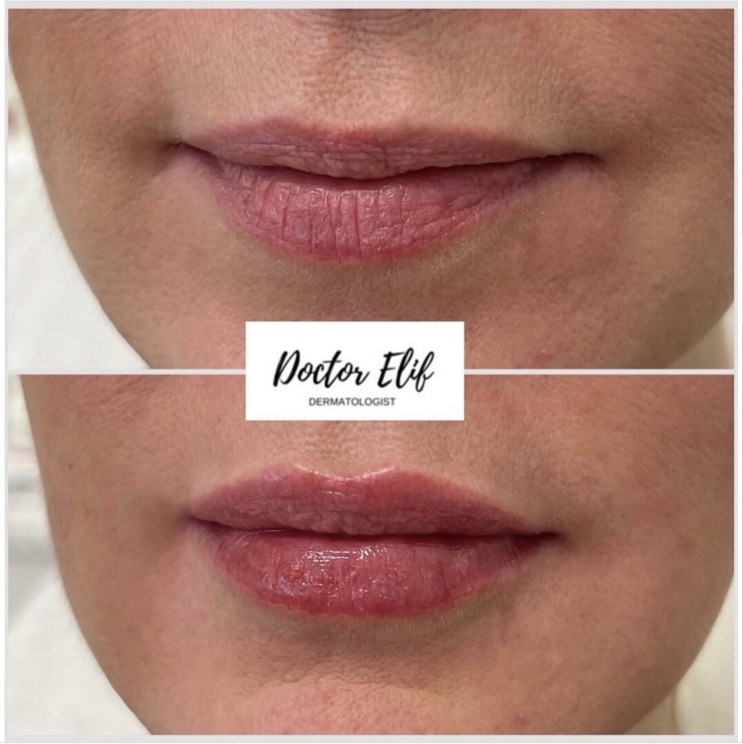 Lip booster injection before and after, Harley Street London