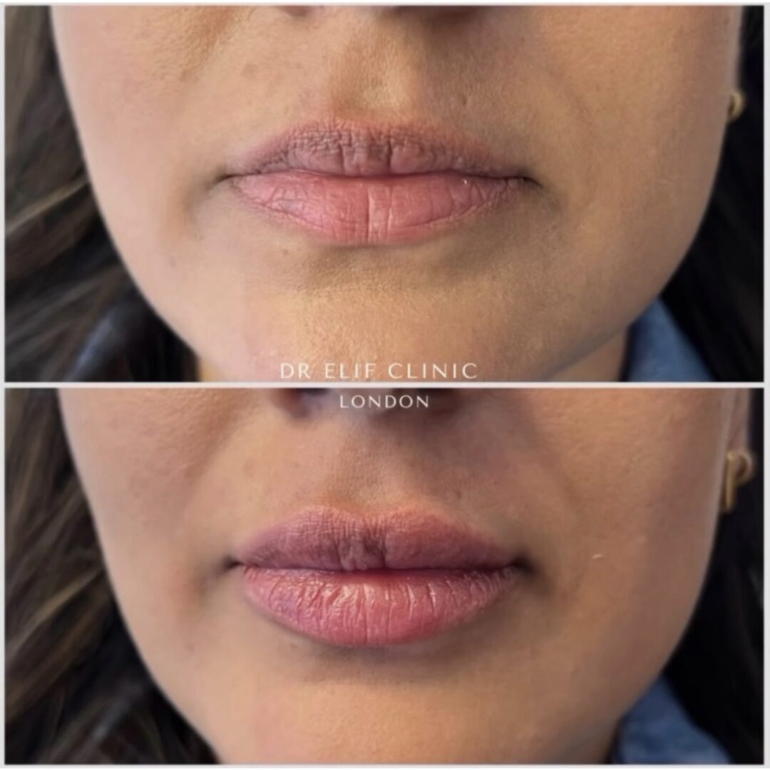 Lip skin booster before and after, Dr Elif Clinic