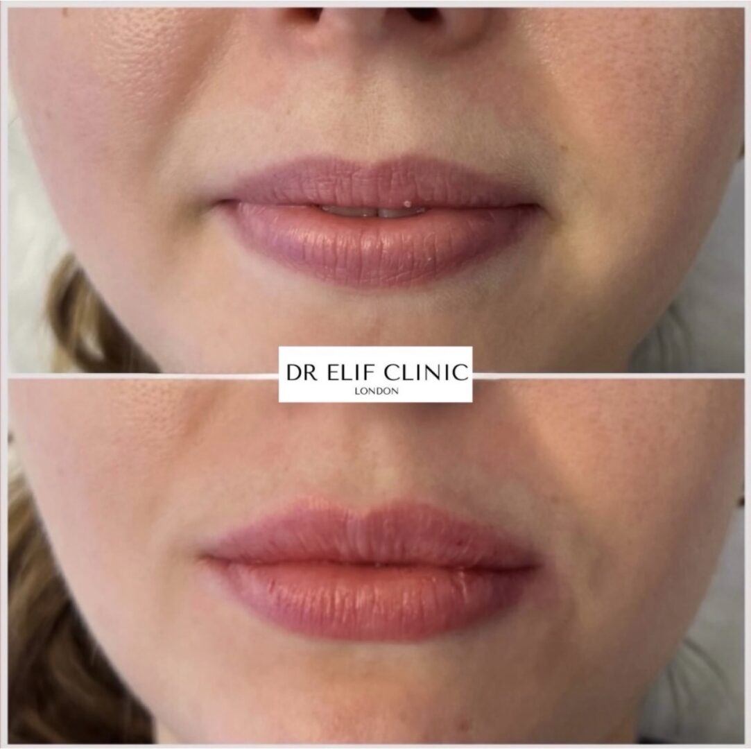 Lip hydration booster before and after, London