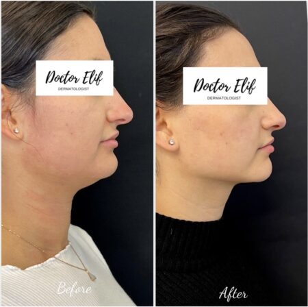 photo of double chin removal with fat dissolving injection before and after result
