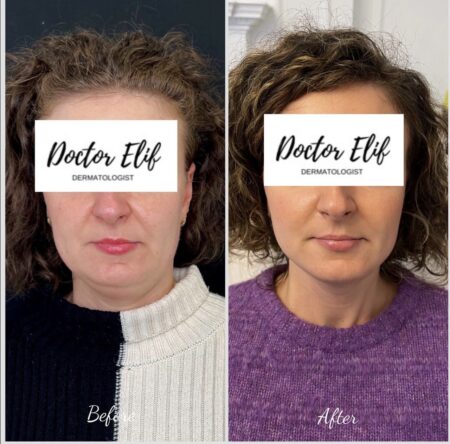 photo of double chin removal with fat dissolving injection before and after result