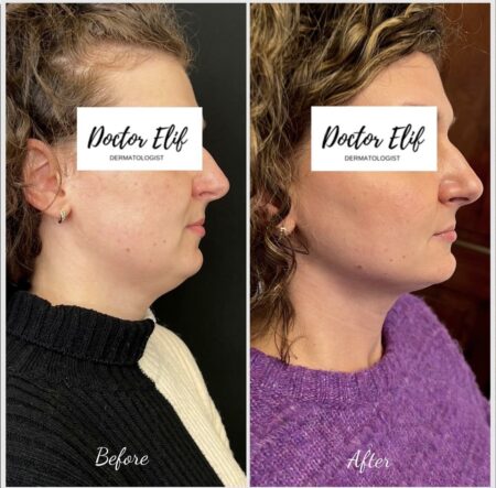 photo of double chin removal with fat dissolving injection before and after result