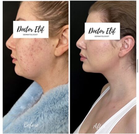 photo of double chin removal with fat dissolving injection before and after result