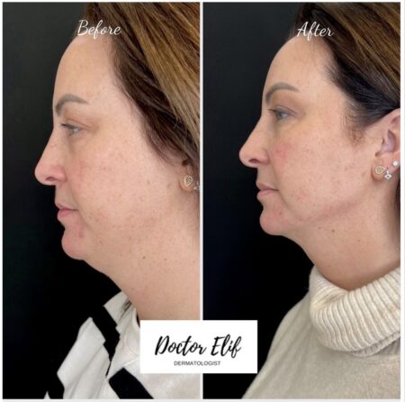 photo of double chin removal with fat dissolving injection before and after result