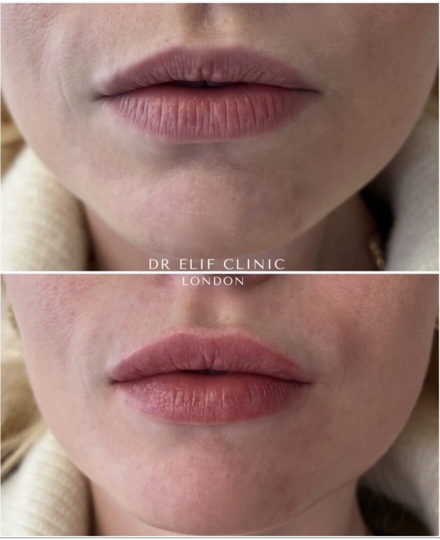 Lip booster treatment before and after, Dr Elif Clinic London