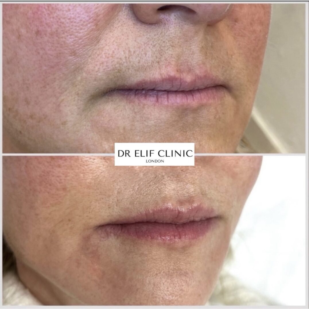 Lip booster results before and after, Harley Street