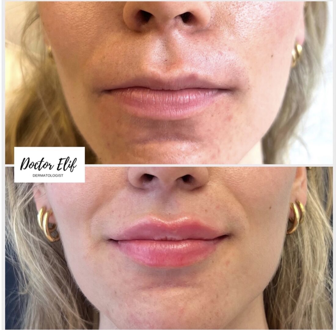 Lip booster before and after – hydrated, naturally fuller lips, Dr Elif Clinic London
