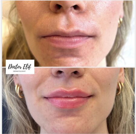 lip booster before and after photo