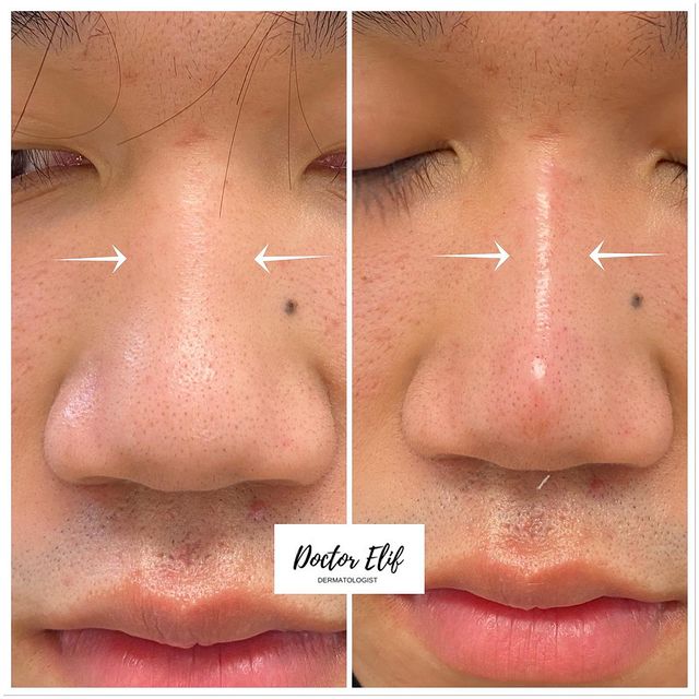 Nose filler