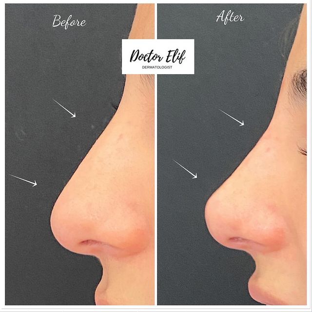 Nose filler