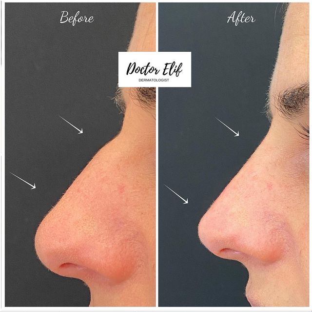 Nose filler