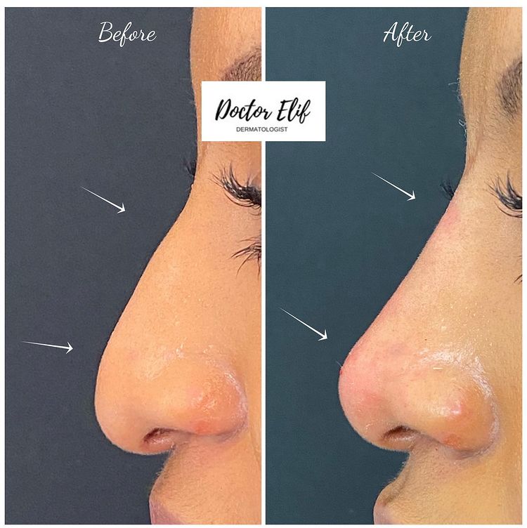 Nose filler