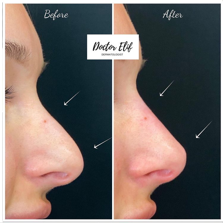 Nose filler