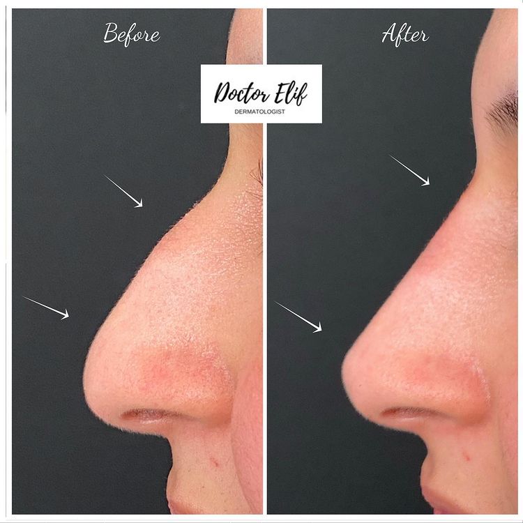 Nose filler