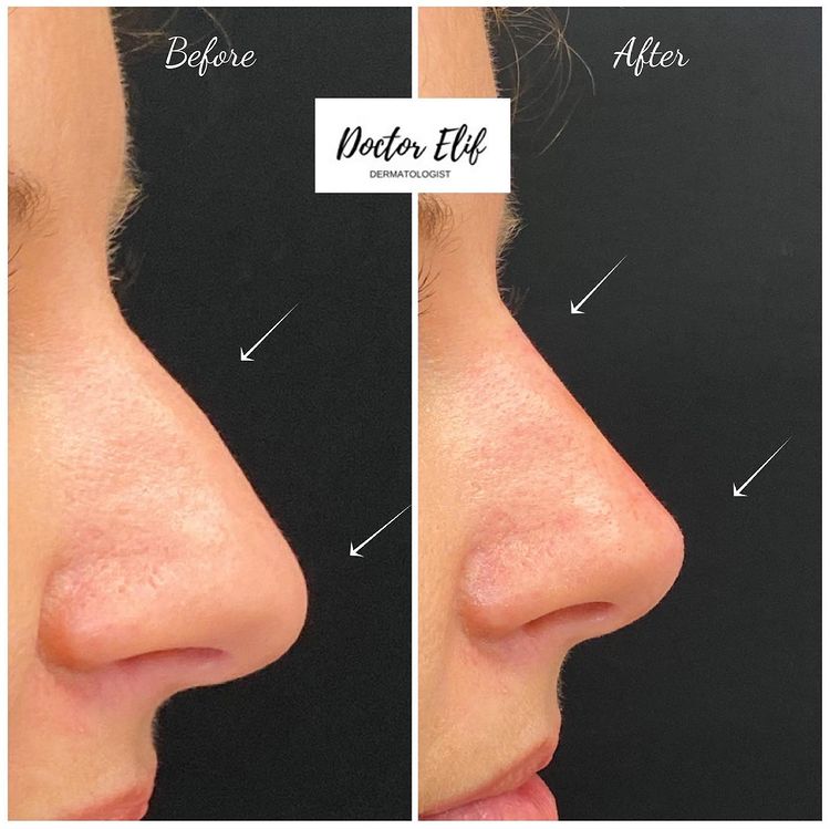 Nose filler